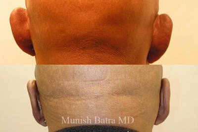 Male Ear Sugery Before & After Gallery - Patient 266876 - Image 1