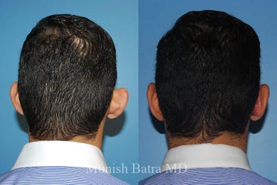 Male Ear Sugery Before & After Gallery - Patient 198712 - Image 1