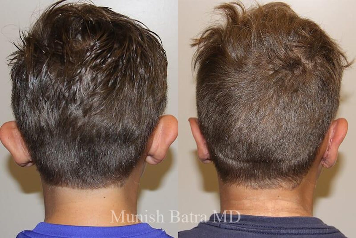 Male Ear Sugery Before & After Gallery - Patient 163352 - Image 1