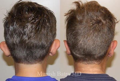 Male Ear Sugery Before & After Gallery - Patient 163352 - Image 1