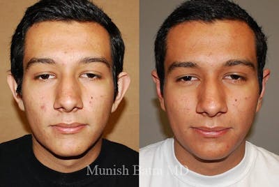 Male Ear Sugery Before & After Gallery - Patient 163383 - Image 1