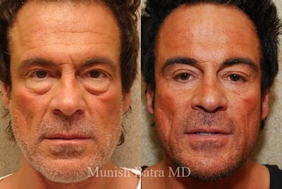 Male Eyelid Surgery Before & After Gallery - Patient 121914 - Image 1