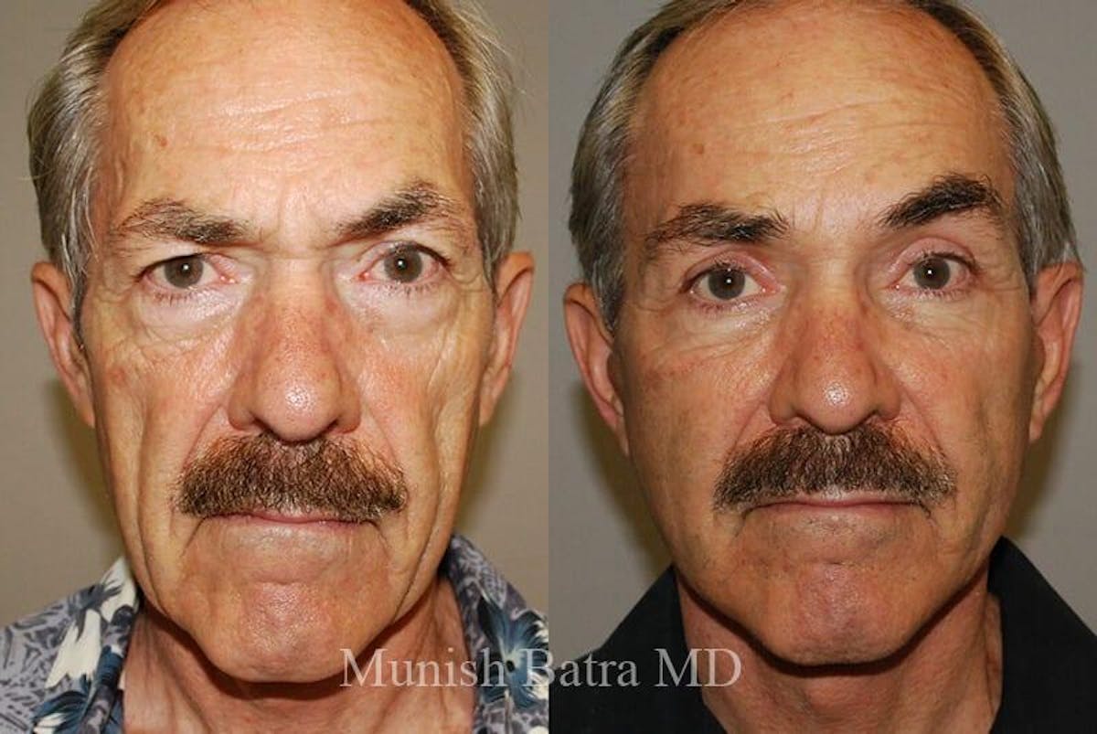 Male Eyelid Surgery Before & After Gallery - Patient 154311 - Image 1