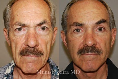 Male Eyelid Surgery Before & After Gallery - Patient 154311 - Image 1