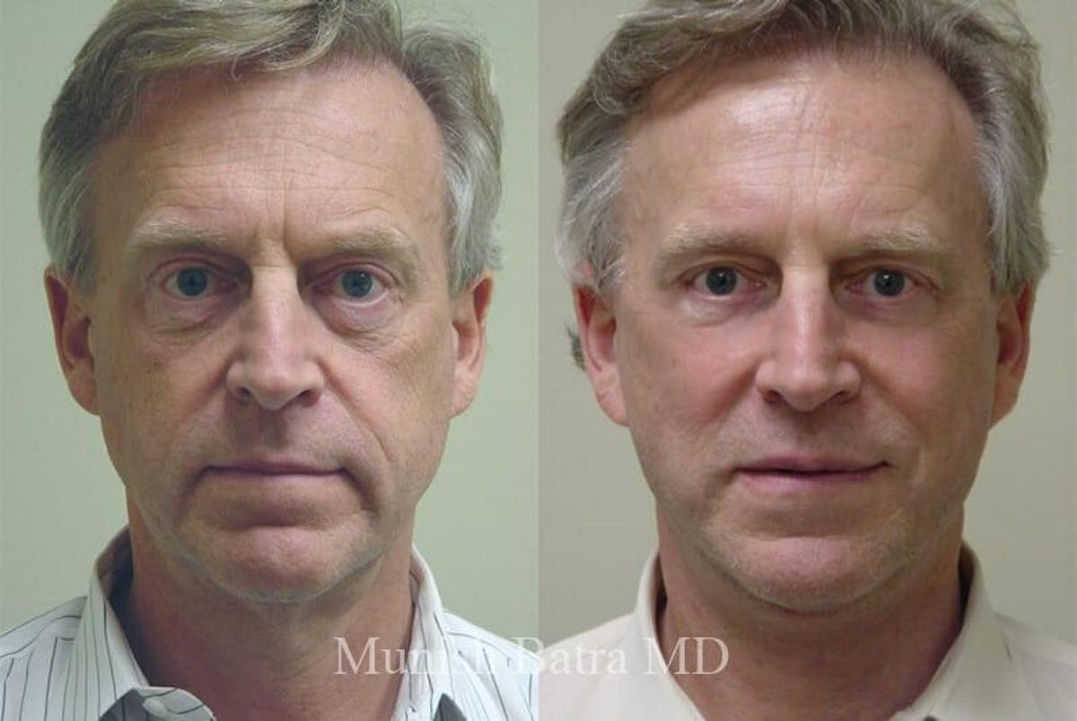 Male Eyelid Surgery Before & After Gallery - Patient 385320 - Image 1