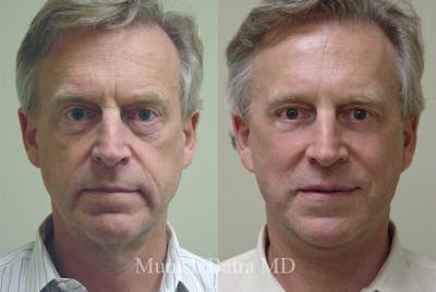 Male Eyelid Surgery Before & After Gallery - Patient 385320 - Image 1
