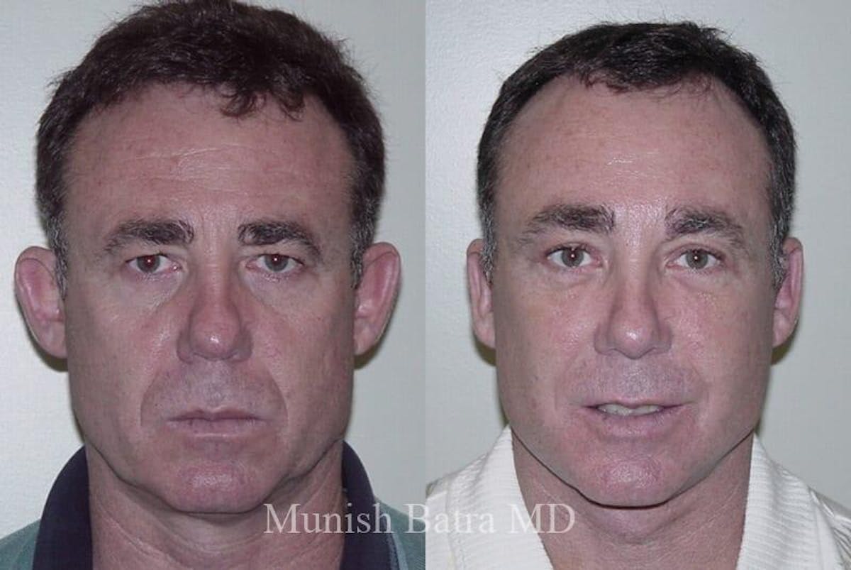 Male Eyelid Surgery Before & After Gallery - Patient 418176 - Image 1