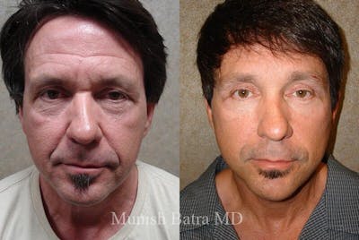 Male Eyelid Surgery Before & After Gallery - Patient 330127 - Image 1