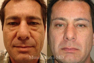 Male Eyelid Surgery Before & After Gallery - Patient 152613 - Image 1
