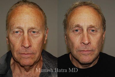 Male Eyelid Surgery Before & After Gallery - Patient 221883 - Image 1