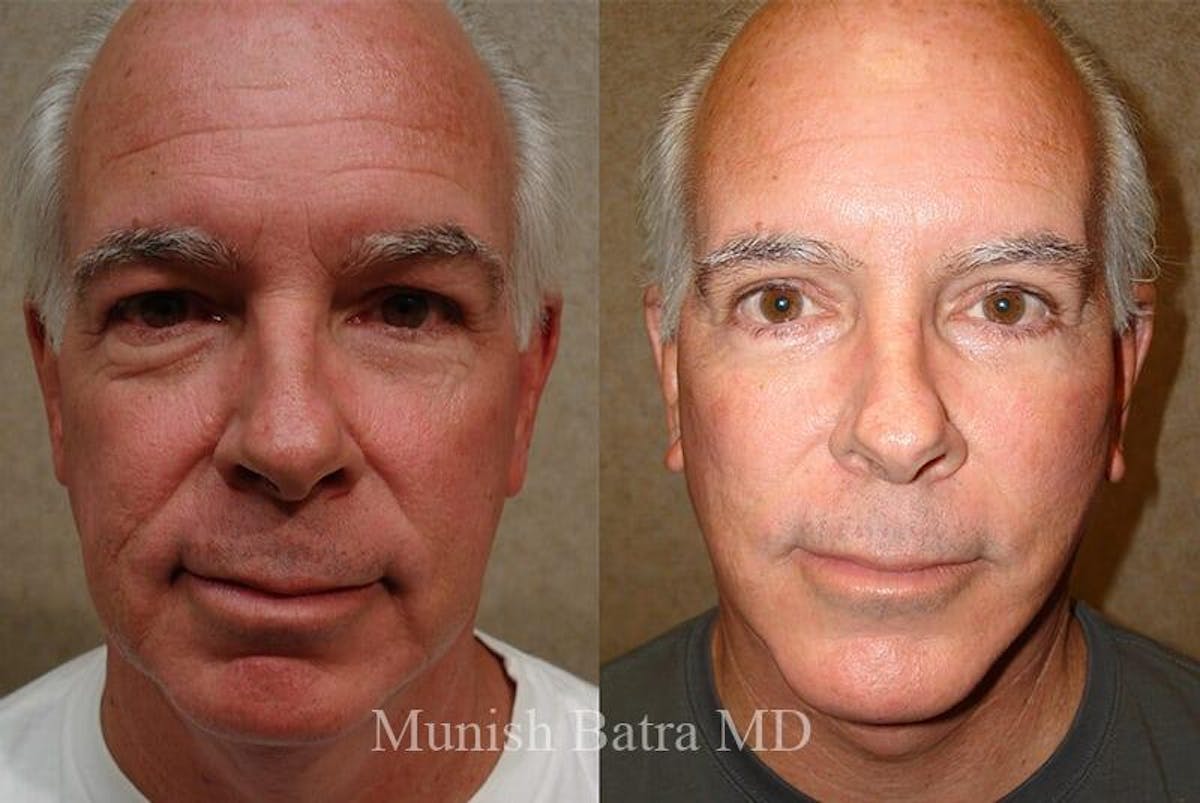 Male Eyelid Surgery Before & After Gallery - Patient 256709 - Image 1