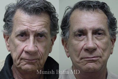 Male Eyelid Surgery Before & After Gallery - Patient 235041 - Image 1