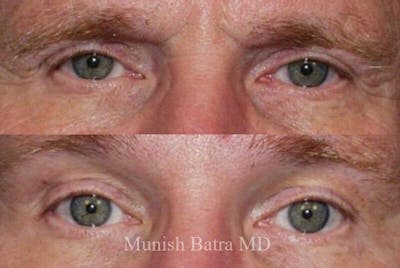 Male Eyelid Surgery Before & After Gallery - Patient 413575 - Image 1