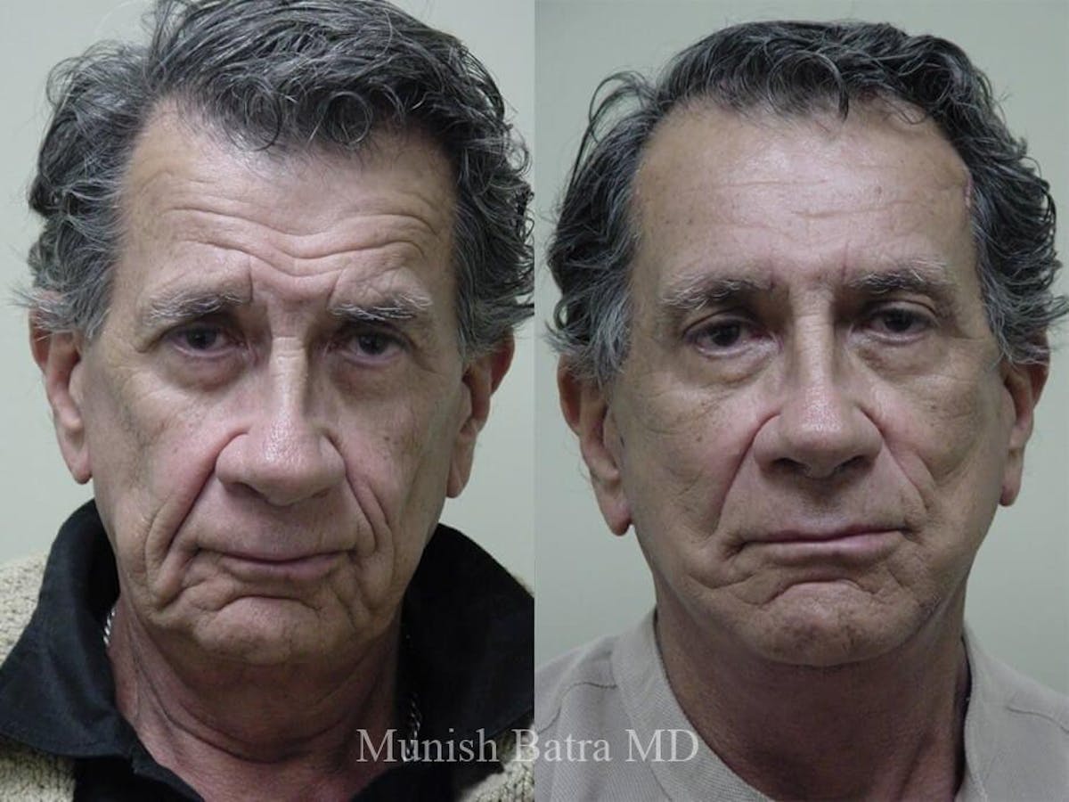 Male Facelift and Neck Lift Before & After Gallery - Patient 395011 - Image 1