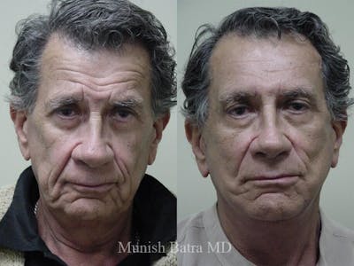 Male Facelift and Neck Lift Before & After Gallery - Patient 395011 - Image 1