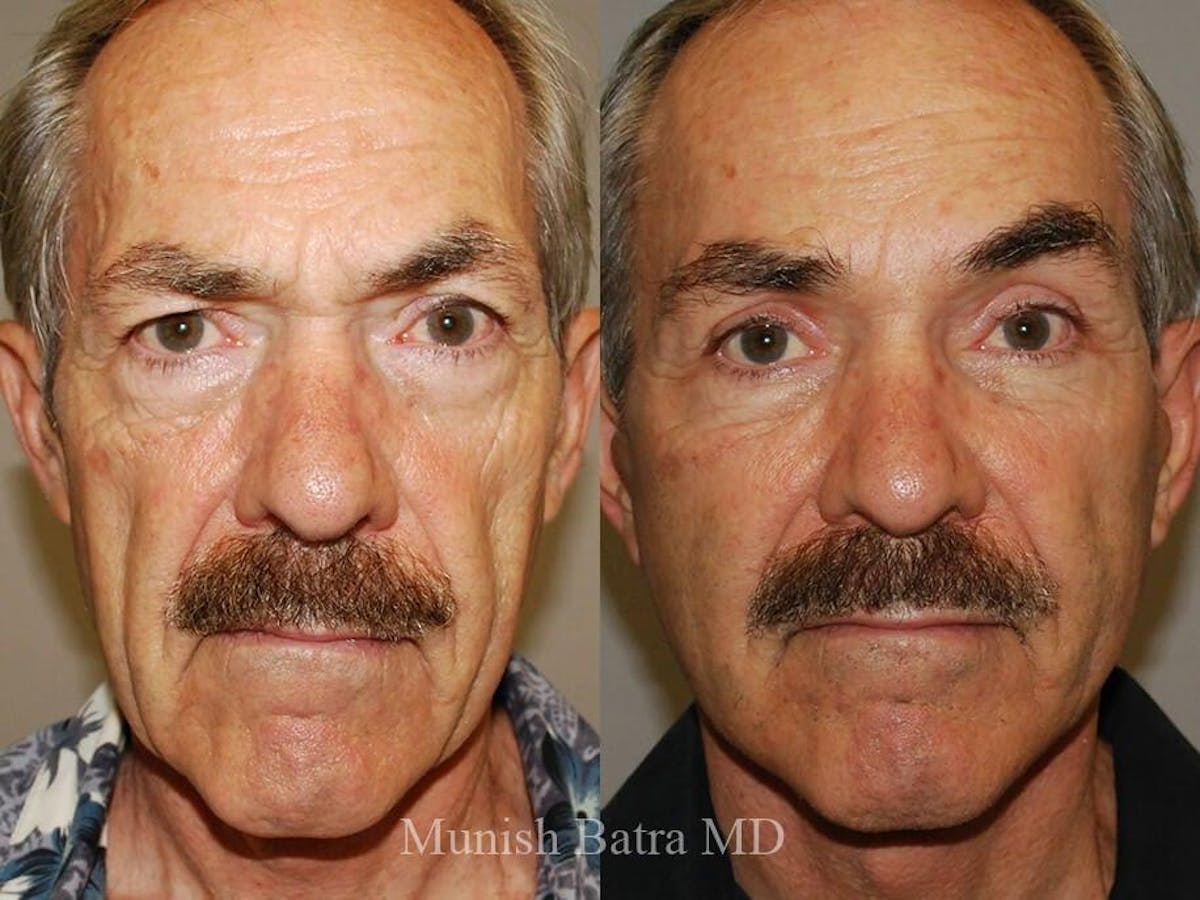 Male Facelift and Neck Lift Before & After Gallery - Patient 337375 - Image 1