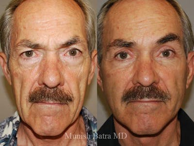 Male Facelift and Neck Lift Before & After Gallery - Patient 337375 - Image 1