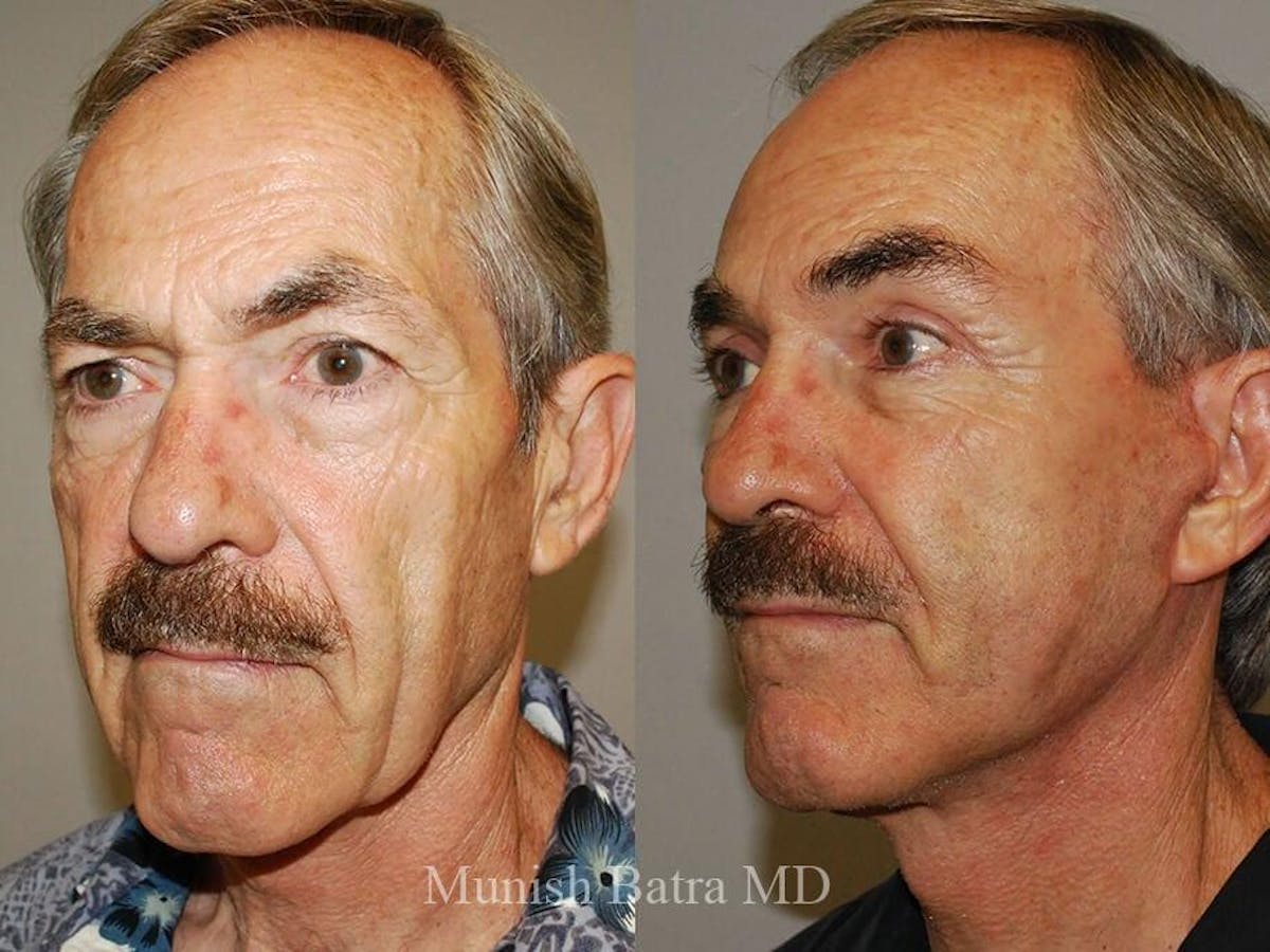 Male Facelift and Neck Lift Before & After Gallery - Patient 337375 - Image 2
