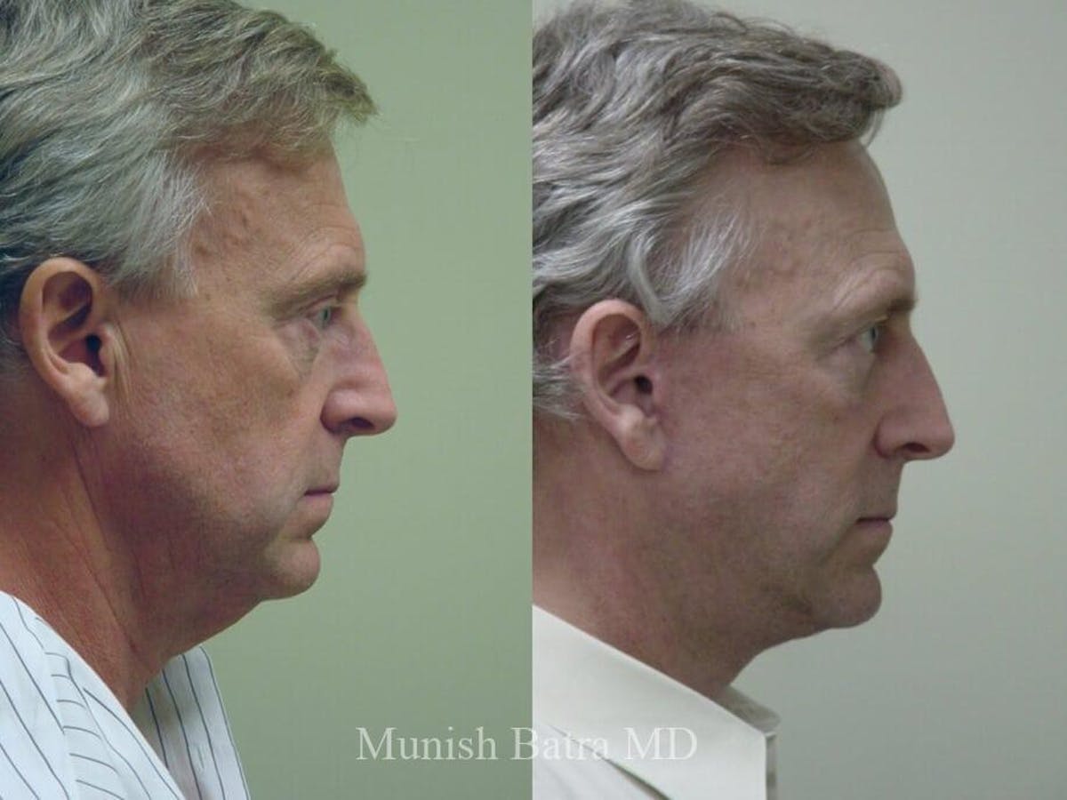 Male Facelift and Neck Lift Before & After Gallery - Patient 534973 - Image 2