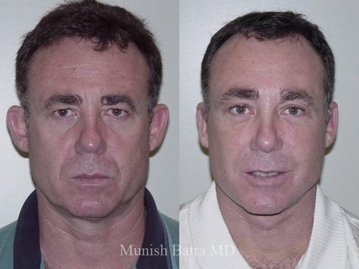 Male Facelift and Neck Lift Before & After Gallery - Patient 343208 - Image 1