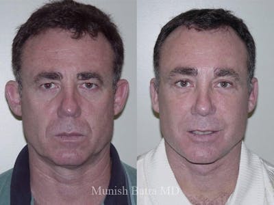Male Facelift and Neck Lift Before & After Gallery - Patient 343208 - Image 1