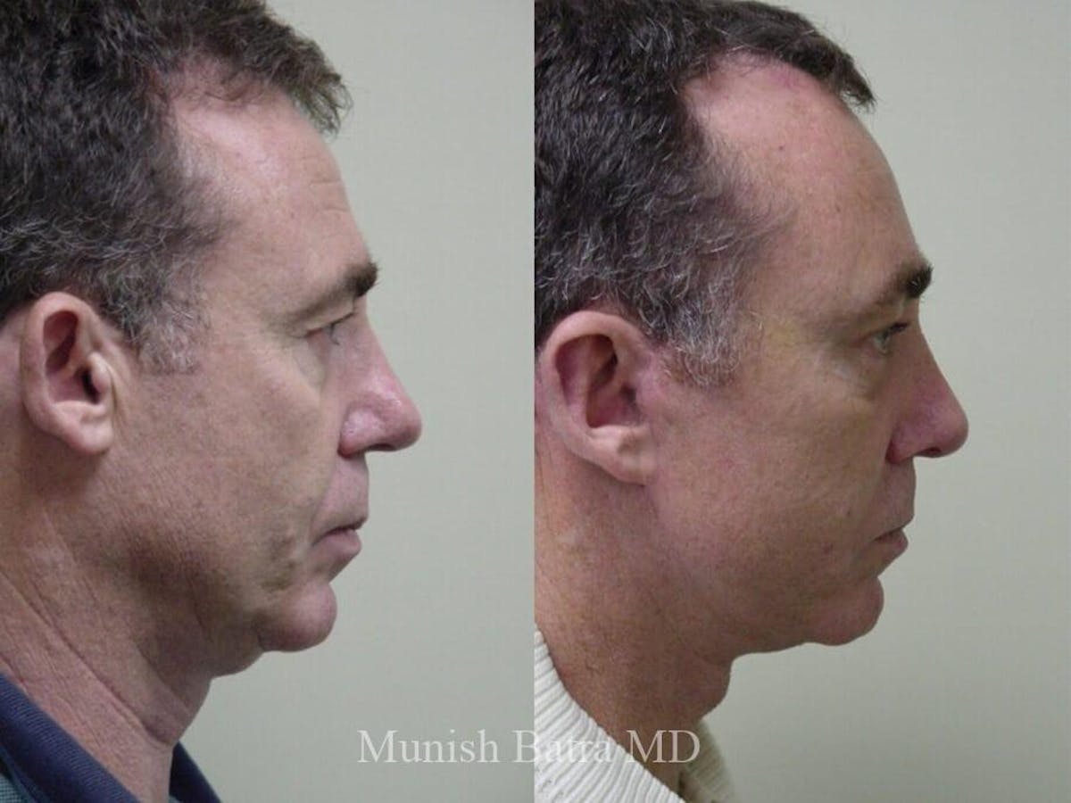 Male Facelift and Neck Lift Before & After Gallery - Patient 343208 - Image 2