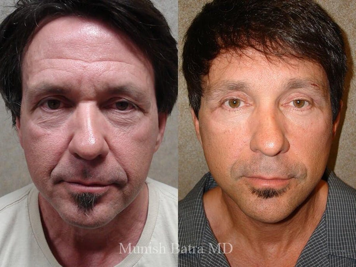 Male Facelift and Neck Lift Before & After Gallery - Patient 422247 - Image 1