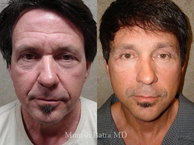Male Facelift and Neck Lift Before & After Gallery - Patient 422247 - Image 1