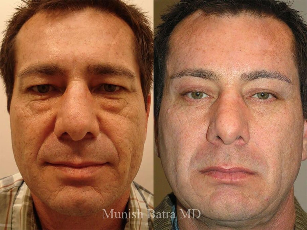 Male Facelift and Neck Lift Before & After Gallery - Patient 117655 - Image 1