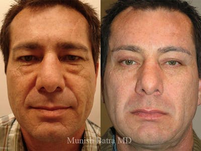 Male Facelift and Neck Lift Before & After Gallery - Patient 117655 - Image 1