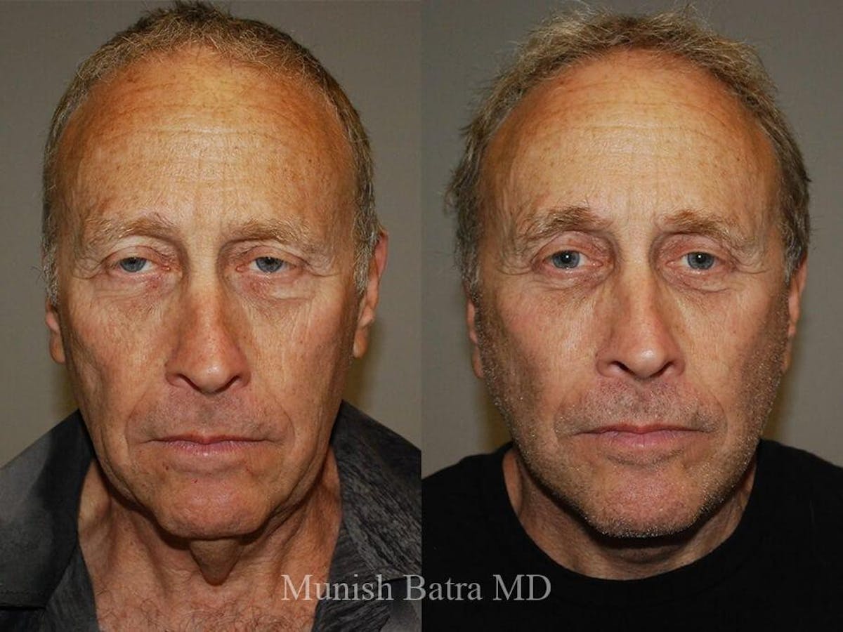 Male Facelift and Neck Lift Before & After Gallery - Patient 352465 - Image 1