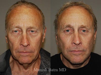 Male Facelift and Neck Lift Before & After Gallery - Patient 352465 - Image 1