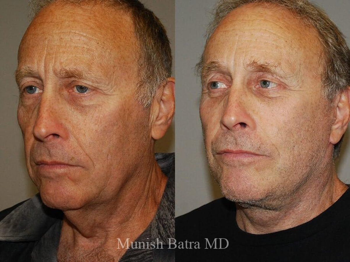 Male Facelift and Neck Lift Before & After Gallery - Patient 352465 - Image 2