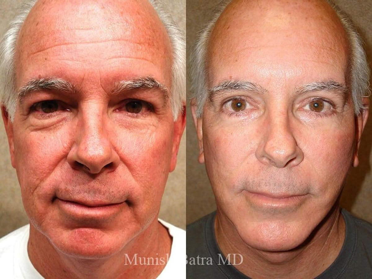 Male Facelift and Neck Lift Before & After Gallery - Patient 355685 - Image 1