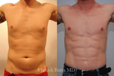 Male Liposuction Before & After Gallery - Patient 116591 - Image 1