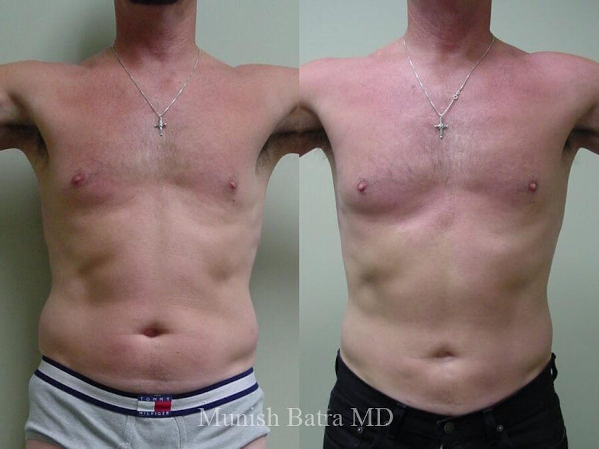 Male Liposuction Before & After Gallery - Patient 265862 - Image 1