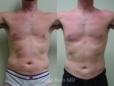 Male Liposuction Before & After Gallery - Patient 265862 - Image 1