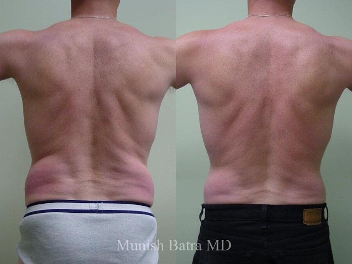 Male Liposuction Before & After Gallery - Patient 265862 - Image 2
