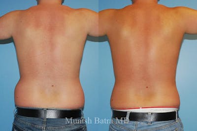 Male Liposuction Before & After Gallery - Patient 402165 - Image 1
