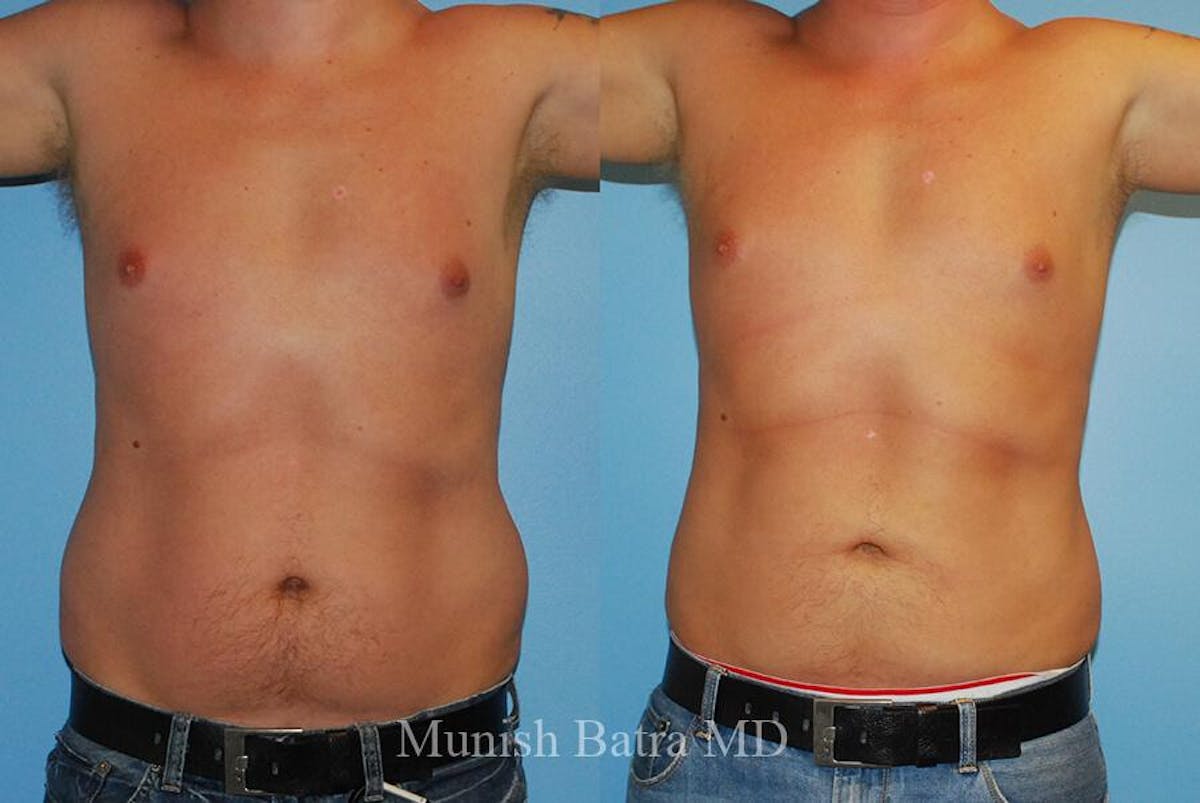 Male Liposuction Before & After Gallery - Patient 402165 - Image 2