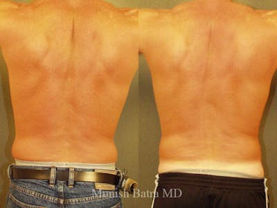 Male Liposuction Before & After Gallery - Patient 350045 - Image 1