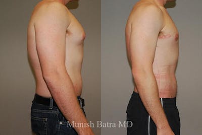 Male Liposuction Before & After Gallery - Patient 181059 - Image 1