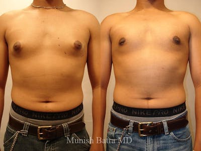 Male Liposuction Before & After Gallery - Patient 224023 - Image 1