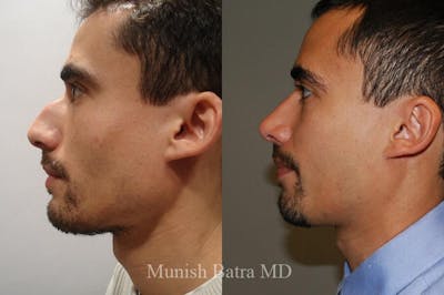 Male Rhinoplasty Before & After Gallery - Patient 198838 - Image 1