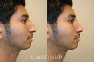 Male Rhinoplasty Before & After Gallery - Patient 135943 - Image 1