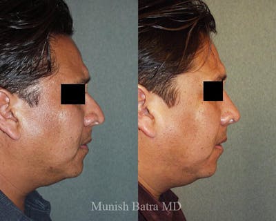 Male Rhinoplasty Before & After Gallery - Patient 383967 - Image 1