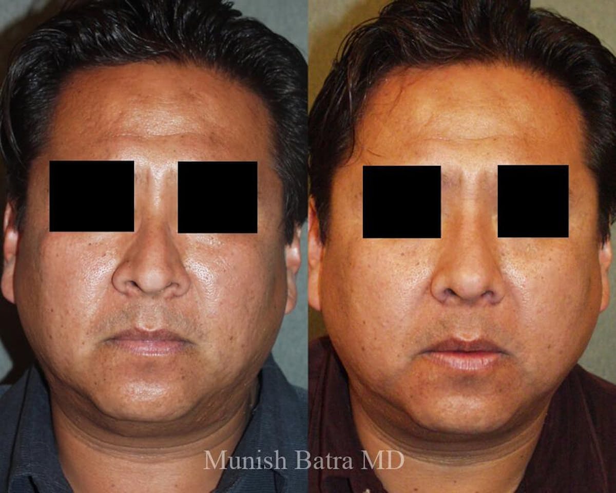 Male Rhinoplasty Before & After Gallery - Patient 383967 - Image 2