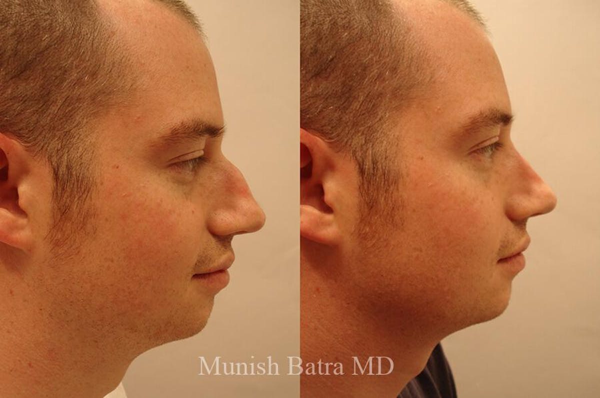 Male Rhinoplasty Before & After Gallery - Patient 198742 - Image 1