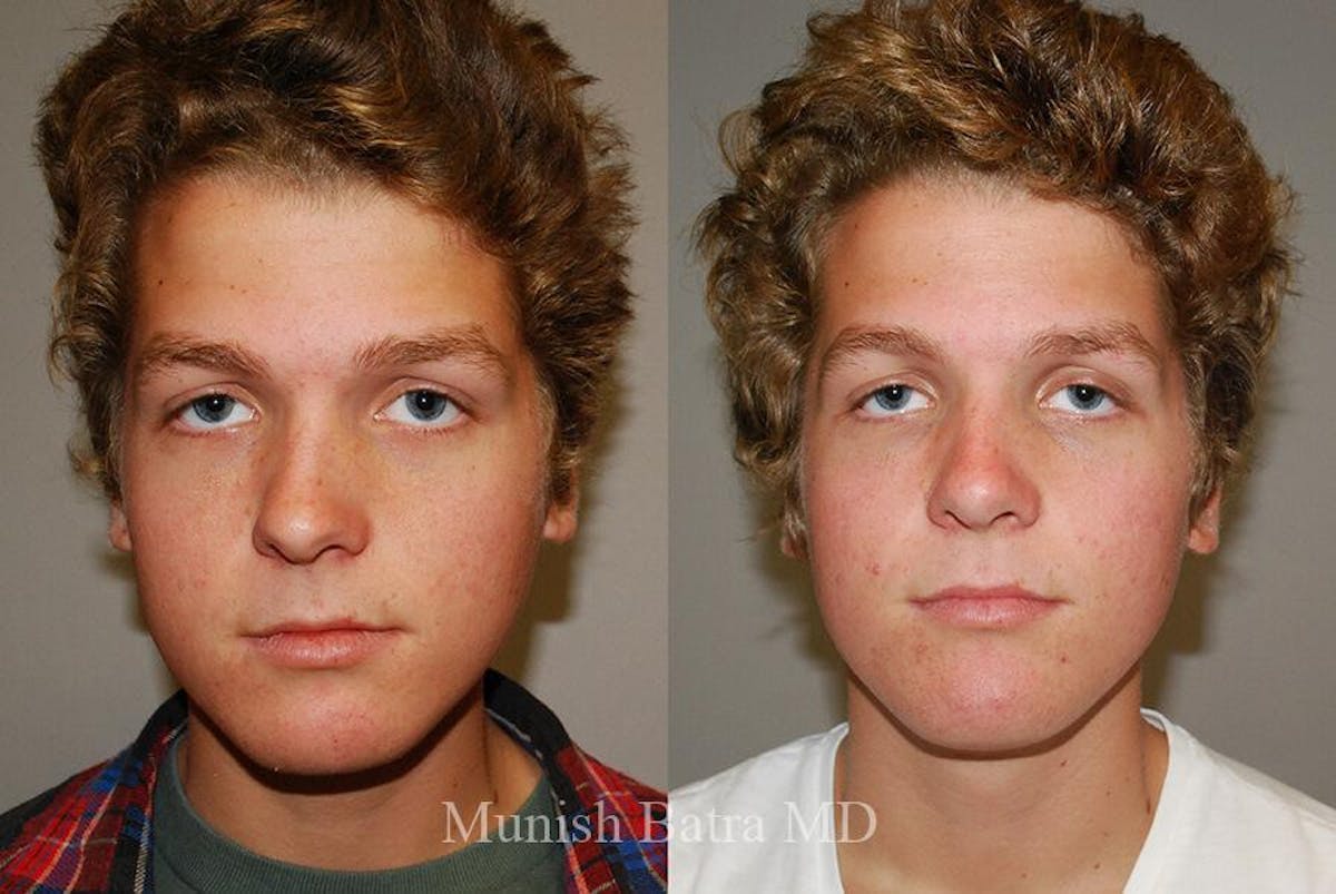 Male Rhinoplasty Before & After Gallery - Patient 245047 - Image 1