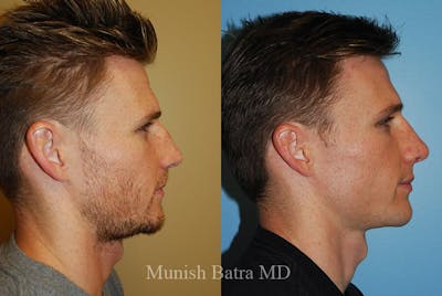 Male Rhinoplasty Before & After Gallery - Patient 156815 - Image 1